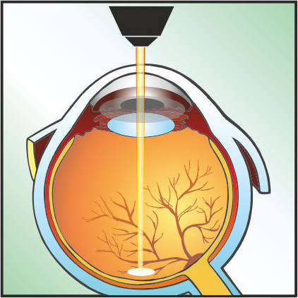 laser-retina